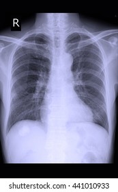 Chest Xray 