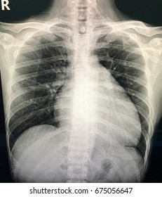 Chest Xray Children Stock Photo 294999080 | Shutterstock