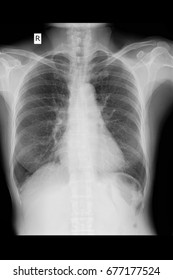 Film Xray Chest Radiograph Cxr Show Stock Photo 1429526900 | Shutterstock