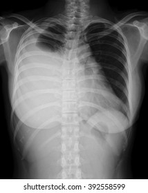 Chest X-ray In A 28 Year Old Female, Acute Upper Respiratory Infection