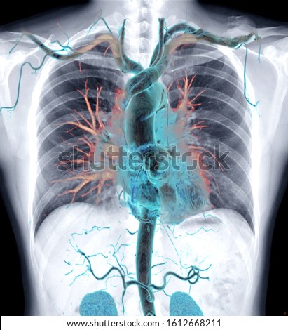 Chest X-ray with 3D rendering image CTA whole aorta inside the chest.