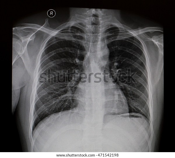 Chest Xray Stock Photo 471542198 | Shutterstock