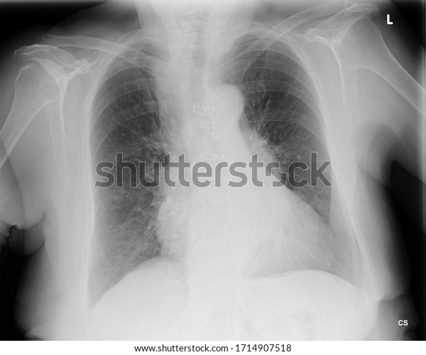 Chest Xray After Median Sternotomy Closed Stock Photo 1714907518 ...