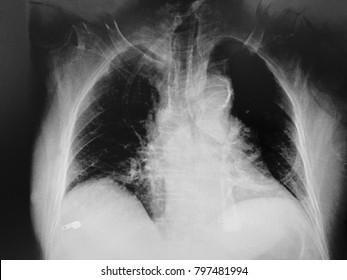 Chest Xray Background Medical Healthcare Concept Stock Photo 797481994