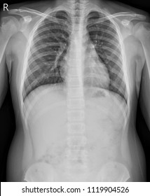 Chest X-ray A Boy 12 Year Old. Show Normal Heart Size And Bony Thorax Impression:Healthy Chest.