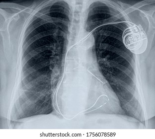chest x-ray with cardiac pacemaker