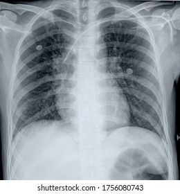 Chest X-ray With Central Venous Catheter