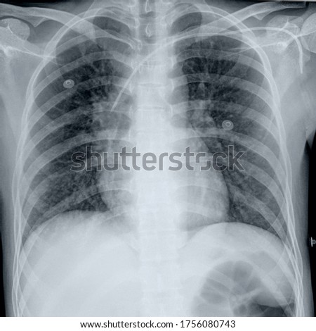 chest x-ray with central venous catheter