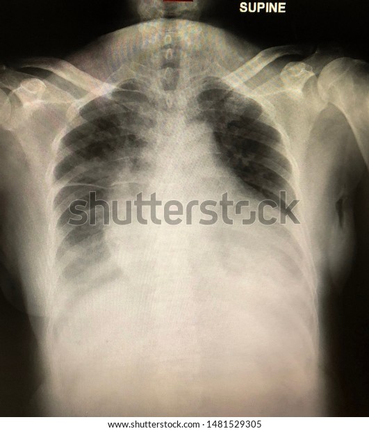 Chest Xray Congestive Heart Failure Patient Stock Photo 1481529305 ...