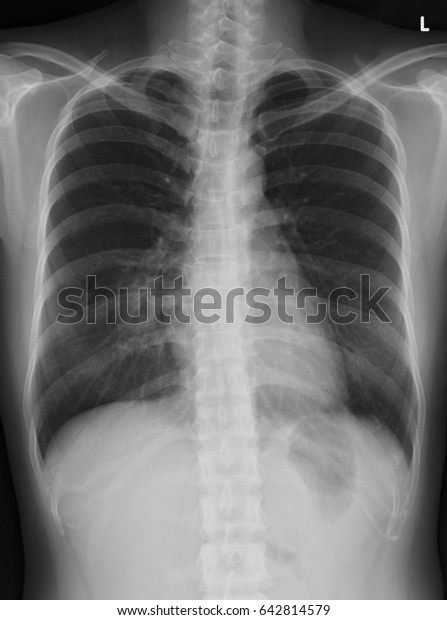 Chest Xray Cxr Image 29 Year Stock Photo 642814579 