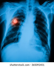 Chest Xray Cxr Image Shows Tumor Stock Photo 365092451 | Shutterstock