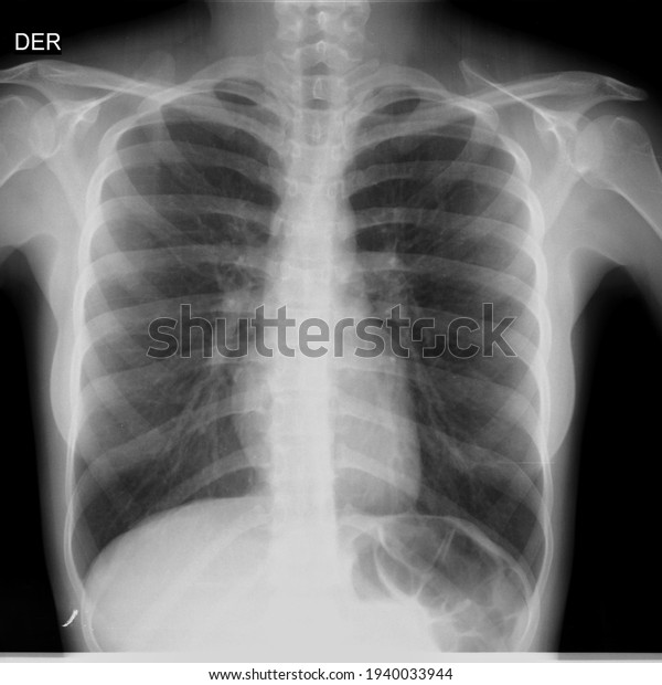 Chest Xray Der Means Right Side Stock Photo (Edit Now) 1940033944