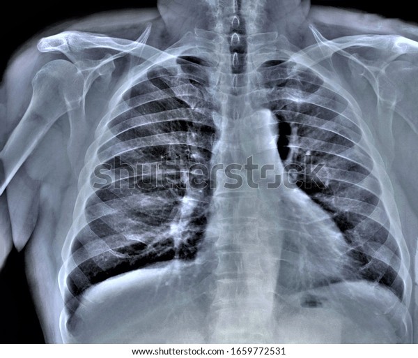 Chest Xray Diagnosis Coronavirus Pneumonia Stock Photo 1659772531 ...