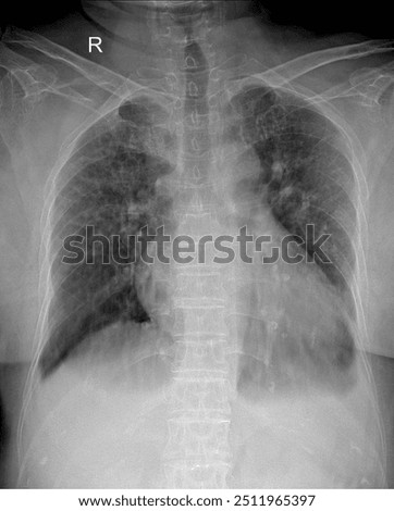Chest X-Ray: A Diagnostic Tool for Lung and Heart Assessment