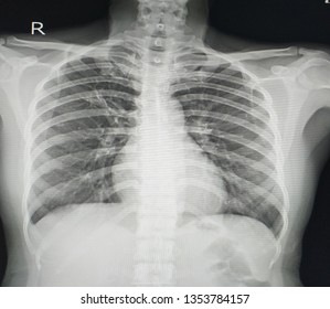 Chest X-ray  A Female 38 Year Old.Finding Mild Peribronchial In Filtration Al RUL In Note.A 1.3 Cm. Nodule At Right Lower Lung Is Nipple Shadow As Correlate With Nipper Marker.