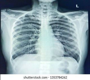 Chest X-ray  A Female 38 Year Old.Finding Mild Peribronchial In Filtration Al RUL In Note.A 1.3 Cm. Nodule At Right Lower Lung Is Nipple Shadow As Correlate With Nipper Marker.