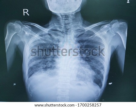Chest x-ray a female 54 year old.histoy cough for 3 months and lost body weight finding Pulmonary TB.Pneumonia,chronic interstitial pneumonitis.