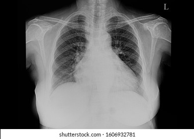 A Chest X-ray Film Of A Female Patient With Cardiomegaly And Pulmonary Edema.