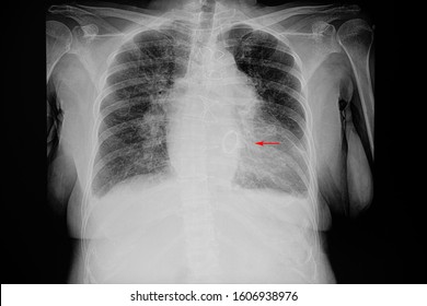 A Chest X-ray Film Of A Female Patient With Cardiomegaly, Pulmonary Edema, And Cardiac Valve Replacement.