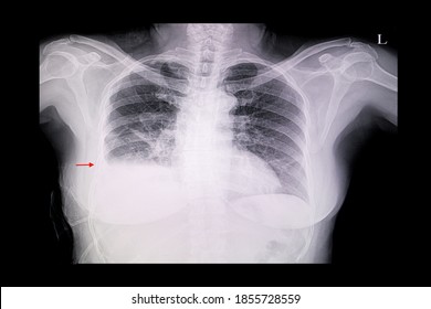 A Chest X-ray Film Of A Female Patient With Cardiomegaly, Pulmonary Edema And Right Lung Pleural Effusion.