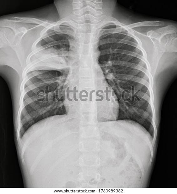 Chest Xray Film Human Sick Pneumonia Stock Photo 1760989382 | Shutterstock