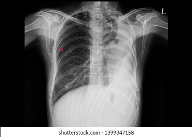 A Chest Xray Film Of A Patient After Left Lung Thoracotomy (surgical Removal Of A Lung).  The Patient Also Has Old Right Rib Fracture.