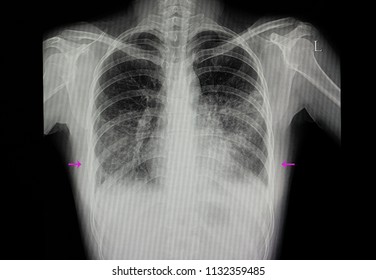 A Chest Xray Film Of A Patient With Bilateral Lower Lungs Pneumonia.  SARS-CoV-2 Virus Covid-19 Infection.