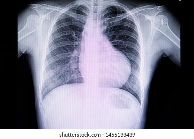 A Chest Xray Film Of A Patient With Boot Shape Heart (right Ventricular Hypertrophy).