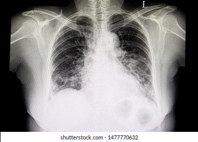 A Chest Xray Film Of A Patient With Cardiomagaly, Congestive Heart Failure And Pulmonary Edema.