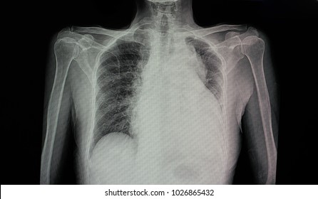 A Chest X-ray Film  Of A Patient With Cardiomegaly With Left Side Heart Failure, Pulmonary Edema, And Pericadial Effusion