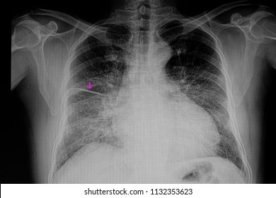 A Chest Xray Film Of A Patient With Cardiomegaly With Congestive Heart Failure And Pulmonary Edema With Fluid In Right Lung Fissure (arrow)