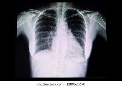 Cardiomegaly Images Stock Photos Vectors Shutterstock