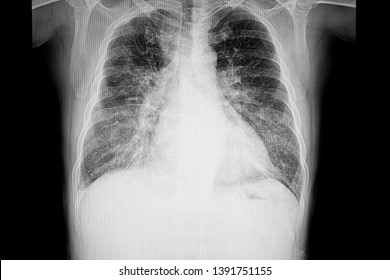 A Chest Xray Film Of A Patient With Cardiomegaly And Pulmonary Edema. 