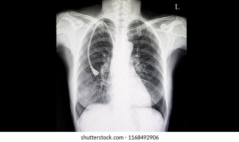 Chest xray film of a patient with double lumen catheter in his right superior vena cava vein. Central line for hemodialysis.