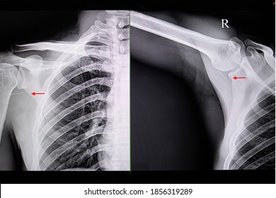 A Chest Xray Film Of A Patient With Lagre Foreign Body (fish Bone)  Retention In Soft Tissue Of Right Shoulder From Accidental Punctate Injury.