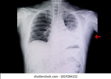 A Chest Xray Film Of A Patient With Left Lung Pneumonia And Pleural Effusion. SARS-CoV-2 Virus Covid-19 Infection.
 