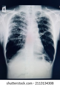 Chest Xray Film Of A Patient With Left Lung Pneumonia And Pleural Effusion. SARS-CoV-2 Virus Covid-19 Infection