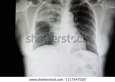 A chest xray film of a patient with lobar pneumonia of his right upper lung. Pulmonary alveolar infiltration. Serious lung infection. Streptococcus bacterial SARS-CoV-2 virus covid-19 infection.

