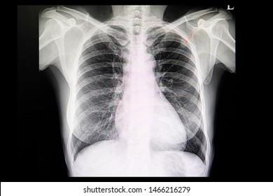 A Chest Xray Film Of A Patient With Lung Nodule  In The Left Upper Lung. 