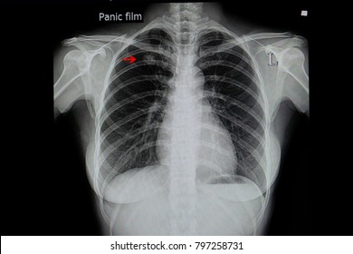 A Chest Xray Film Of A Patient With A  Lung Nodule In His Right Upper Lung