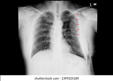 A Chest Xray  Film Of A Patient With Multiple Rib Fractures (second To Eight)  And Left Lung Hemothorax.