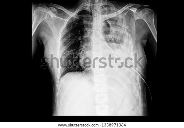 Chest Xray Film Patient Multiple Left Stock Photo (Edit Now) 1358971364