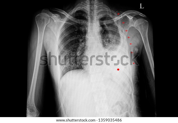 A chest xray film of a patient with multiple rib\
fractures (rib 1 to 8) with left side large hemothorax.  Chest\
radiology image in trauma and accident. Flail chest. Red arrows\
mark fracture areas.