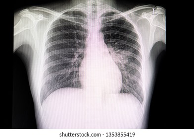 A Chest Xray Film Of A Patient With Pneumonia Or Pneumonitis.  The Patient Has Alveolar Infiltration In The Left Middle Lungs. Pulmonary Tuberculosis,SARS-CoV-2 Virus Covid-19 Infection.
