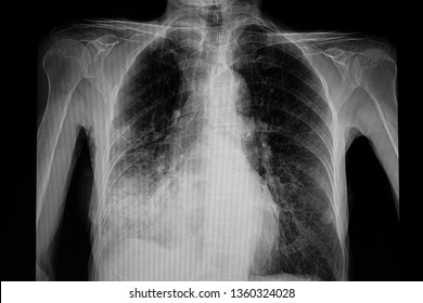 A Chest Xray Film Of A Patient With Pneumonia In The Right Lower Lung. Pulmonary Infection. SARS-CoV-2 Virus Covid-19 Infection.
