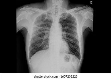 Pneumonitis Images Stock Photos Vectors Shutterstock