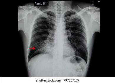 A Chest Xray Film Of A Patient With A Pneumonia In His Right Lower Lobe. SARS-CoV-2 Virus Covid-19 Infection.
