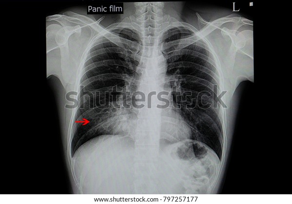 Chest Xray Film Patient Pneumonia His Stock Photo (Edit Now) 797257177