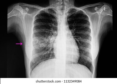 Chest Xray Film Of A  Patient With Right Middle Lobe Pneumonia. SARS-CoV-2 Virus Covid-19 Infection.
 
 