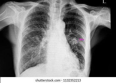 A Chest Xray Film Of A Patient With Right Middle And Lower Lobes Pneumonia, Left Lower Lobe Pneumonia, And Left Middle Lung Nodule. SARS-CoV-2 Virus Covid-19 Infection.